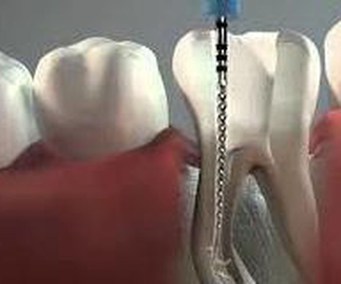 Endodoncia: Servicios  de Clínica Dental Sanclemente