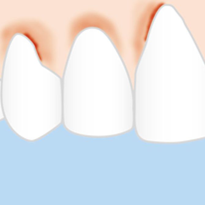 Cómo se puede prevenir la periodontitis