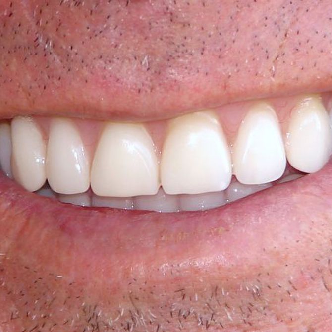 La microestructura del esmalte dental