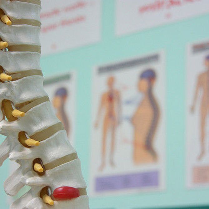 Fracturas de columna vertebral por osteoporosis