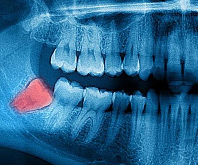 Cirugía bucal: Especialidades de Clínica Dental Dr. Yagüe