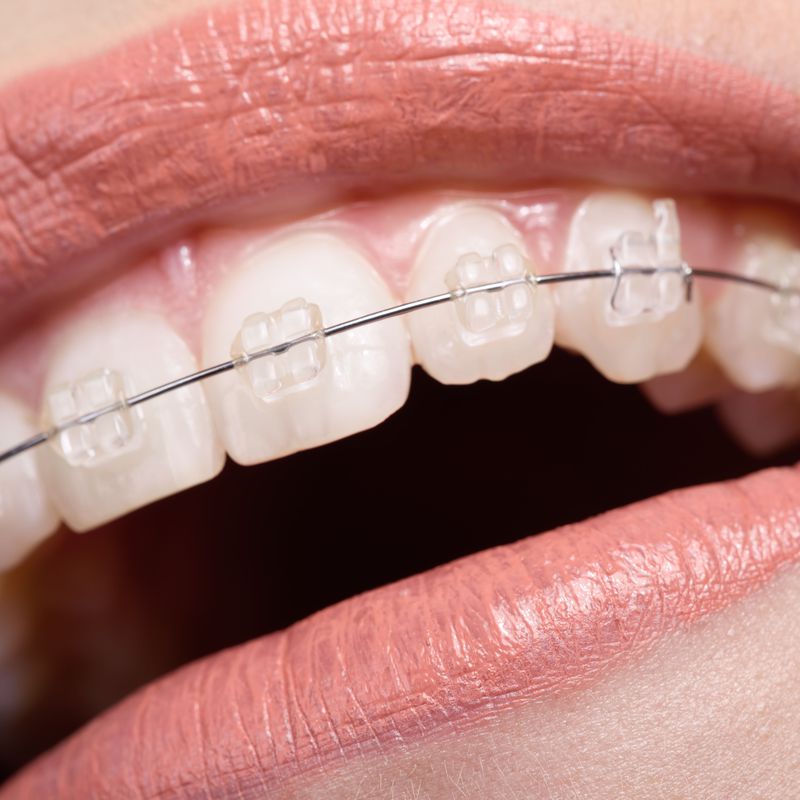 Ortodoncia: Nuestros Servicios de Bonestar Clínica Dental