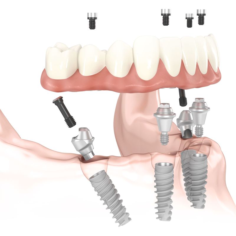 Implantología: Tratamientos de Clínica Dental García Villagrá