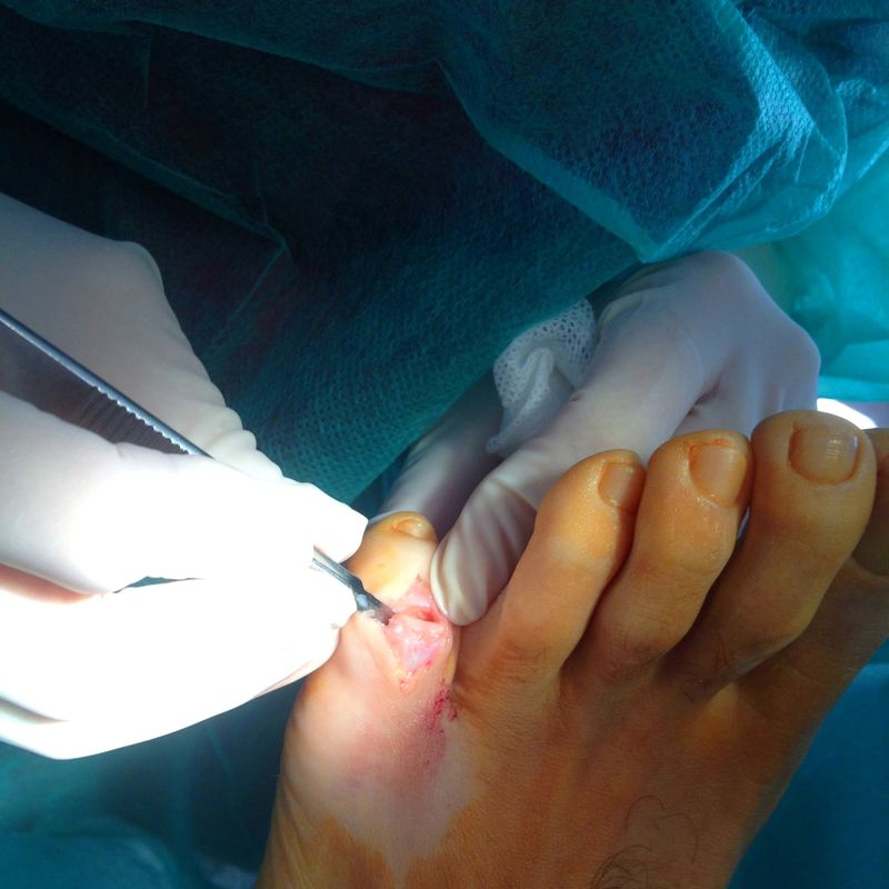 Cirugía podológica: Tratamientos de Clínica Payá Podología