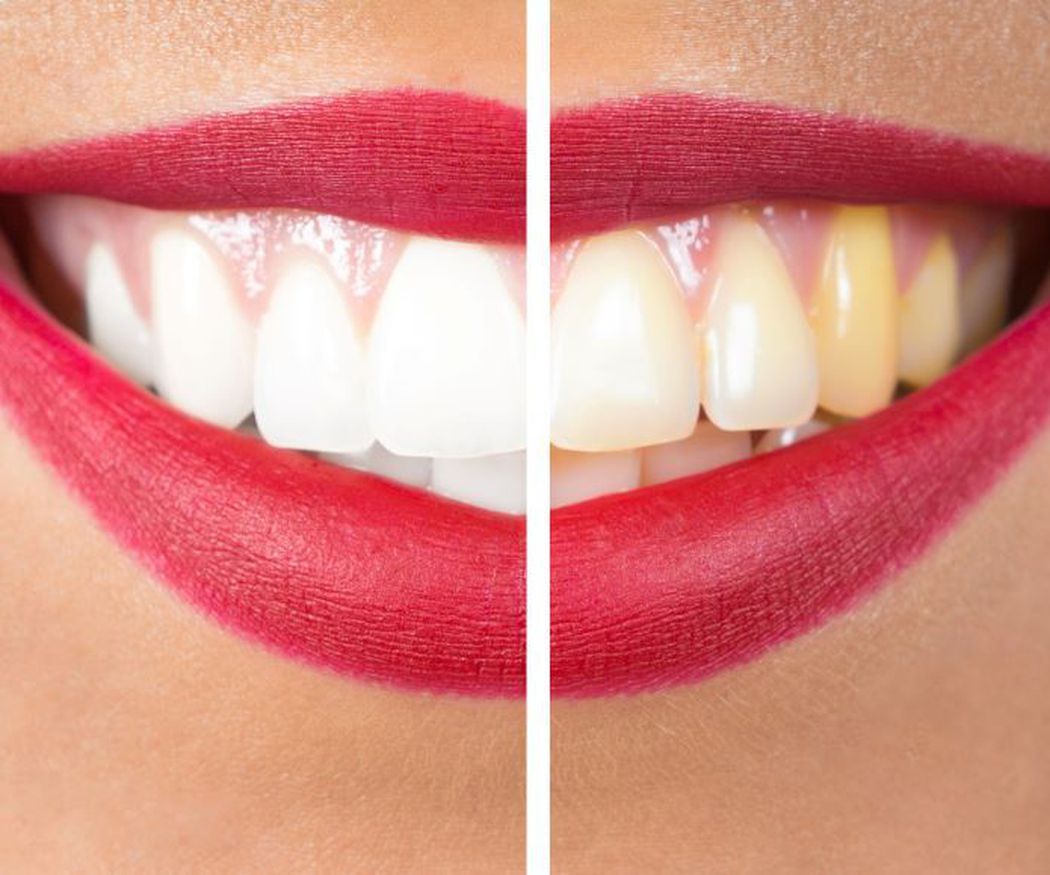 ¿Conoce los beneficios del blanqueamiento dental?