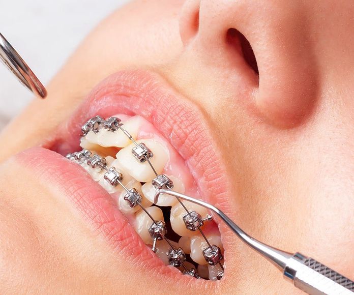 Ortodoncia: Tratamientos de CLIESDENT - Clínica de Especialistas Dentales }}