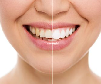 Estética dental: Tratamientos dentales de Dr. Joaquín Artigas