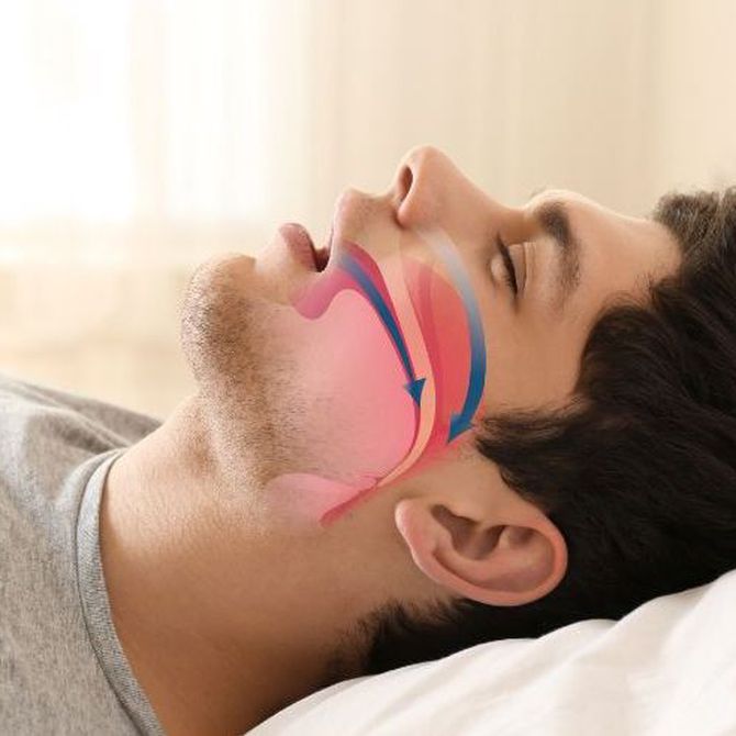 Los peligros de la apnea del sueño