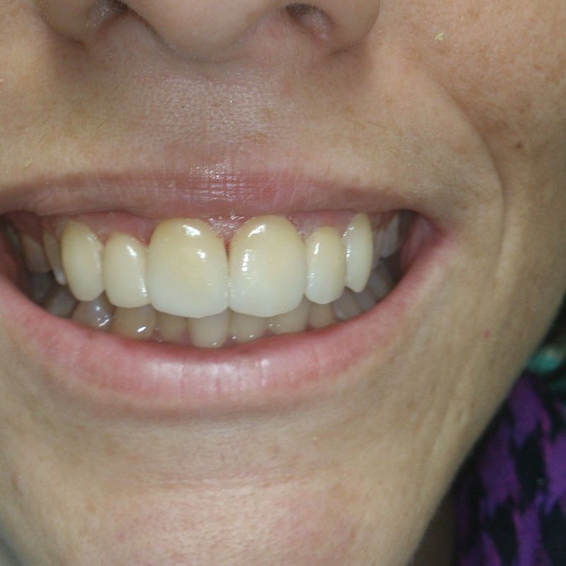 Carillas porcelana: Tratamientos de Clínica Dental Tucán