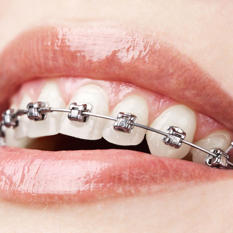 Ortodoncia: Tratamientos de Dental Valls