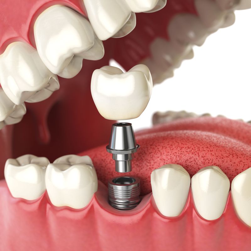 Implantes dentales: Servicios de Marta Martínez Clínica Dental