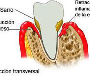 Periodontitis