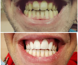 Blanqueamiento dental: Tratamientos de Hospident Clínica Dental
