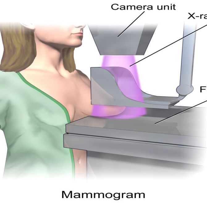 Los orígenes de las mamografías