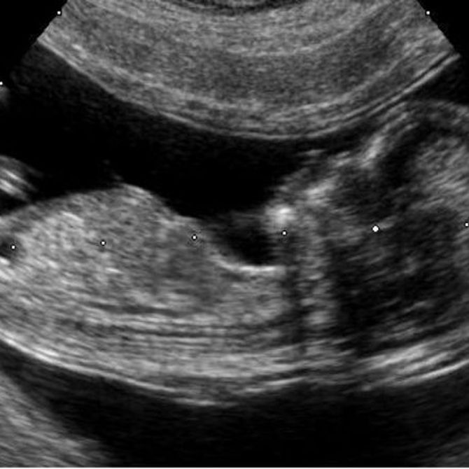 ¿Qué es el diagnóstico prenatal?