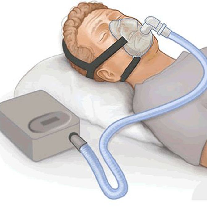 Dispositivos de avance especiales para evitar la apnea del sueño 