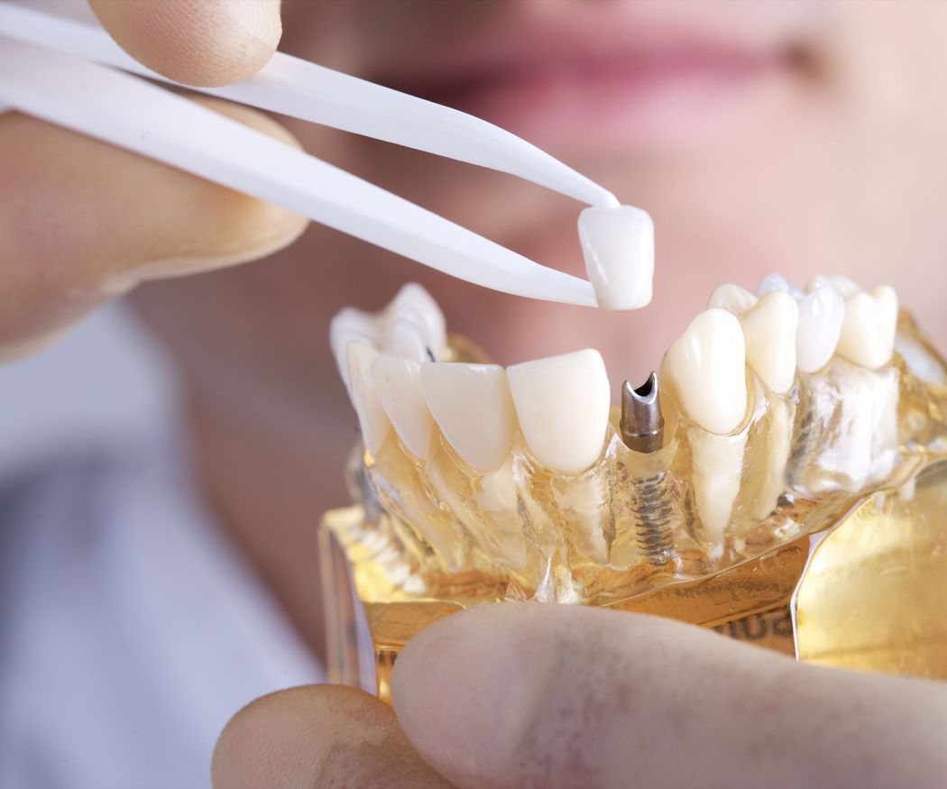 Hábitos que pueden dañar tus dientes