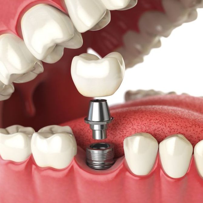 ¿Qué sabes sobre los implantes dentales?