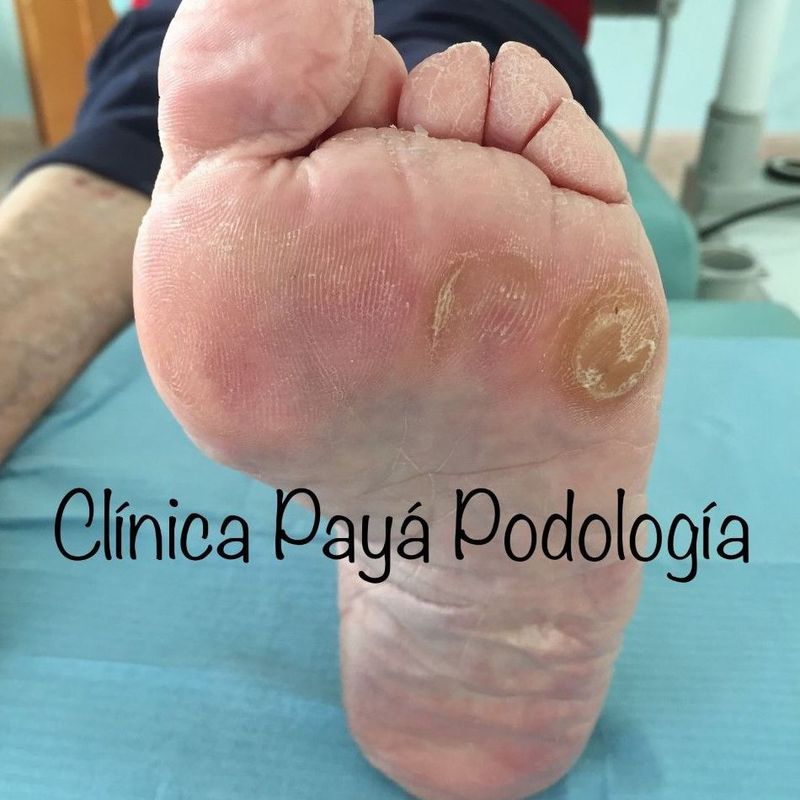 Podología Geriátrica: Tratamientos de Clínica Payá Podología