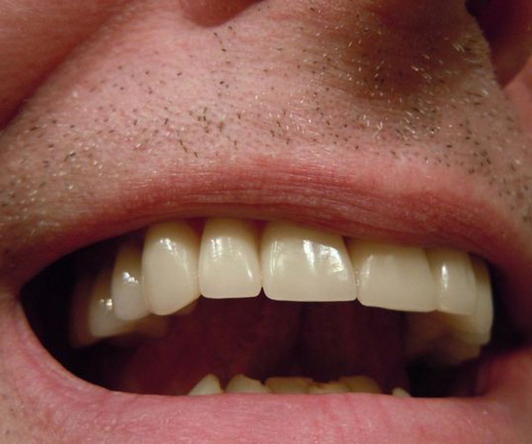 El Composite que emplean los odontólogos