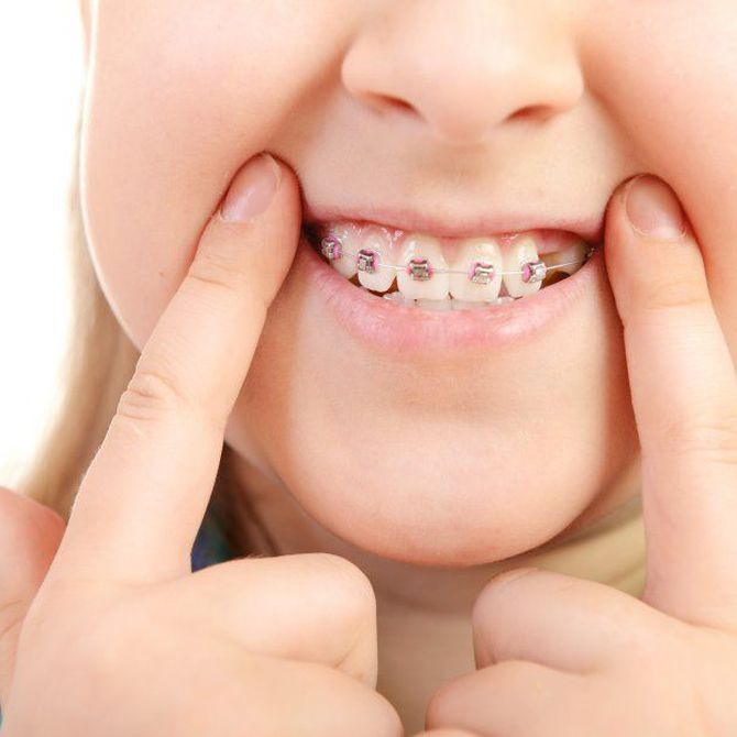 ¿A qué edad se debe poner la ortodoncia?