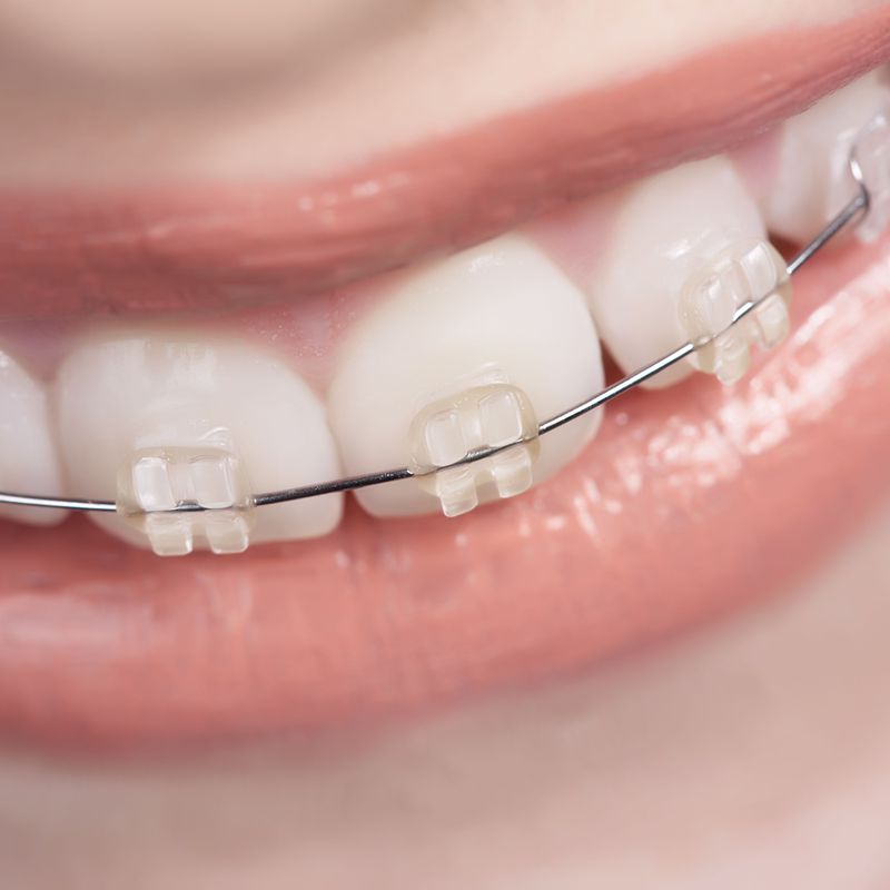Ortodoncia con brackets convencionales: Servicios de Clinica Dental Garó