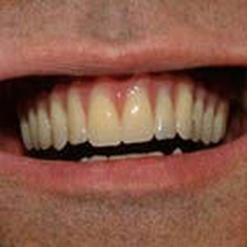 Implantes dentales: Servicios de Clínica Implanteoral Milladoiro