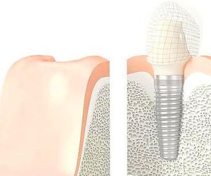 La naturalidad, el último reto de los implantes dentales