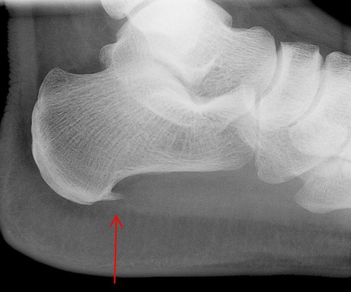 Fascitis plantar: Tratamientos de Pacientes particulares