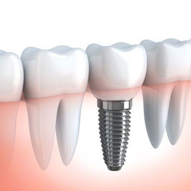 5 pautas básicas para cuidar tus implantes dentales