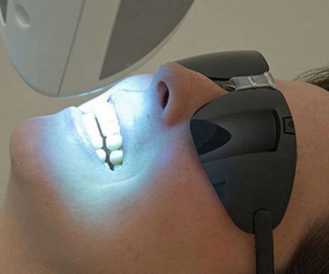 Técnicas de blanqueamiento dental