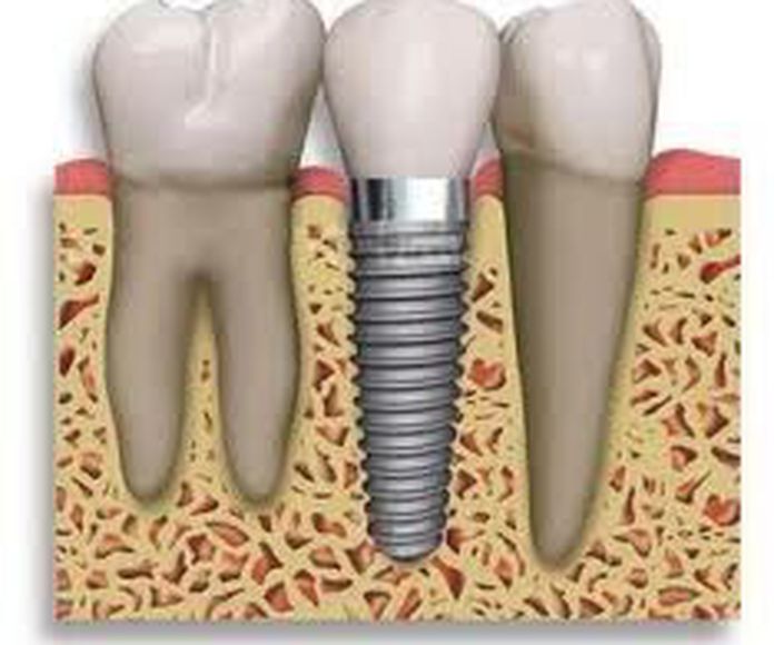 Implantología: Odontología y Terapias de Centre Odontològic Sant Quirze