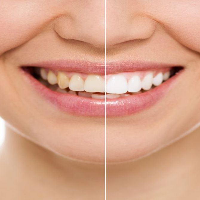¿Qué es el blanqueamiento dental?