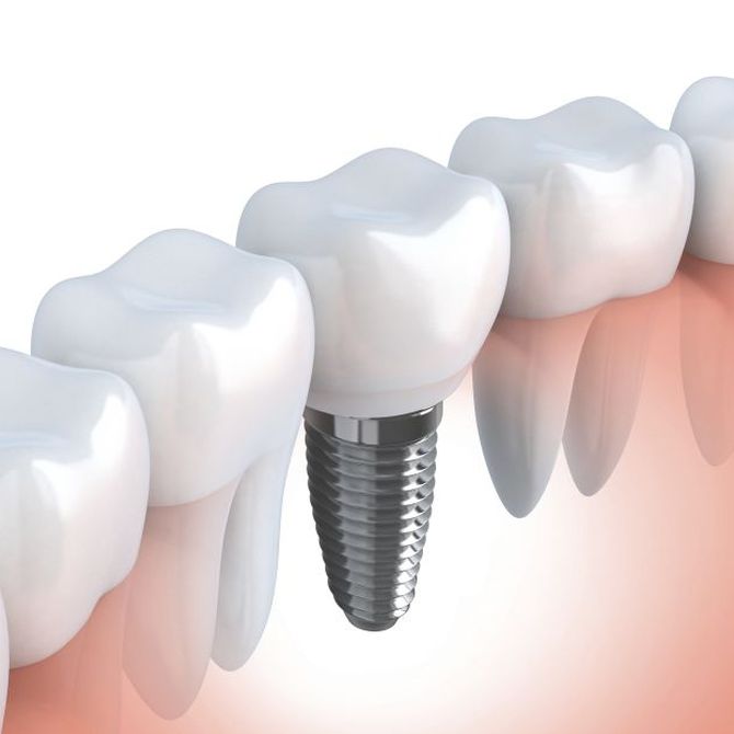 ¿Cómo se sujetan los implantes dentales?