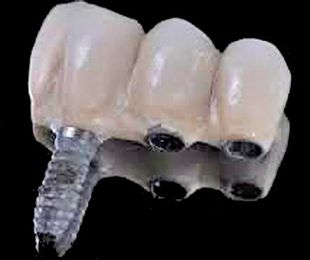 Los nuevos implantes dentales sin cirugía