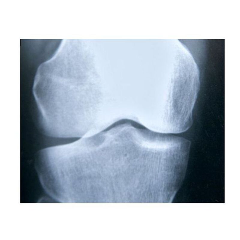 Osteoporosis: Nuestros Tratamientos de HOSPITAL RECOLETAS DE SEGOVIA