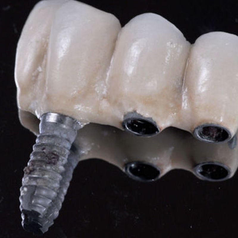 Implantes: Tratamientos de Clínica Dental Palamadent