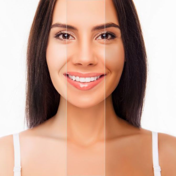 ¿Qué relación tiene la melanina con la depilación láser?