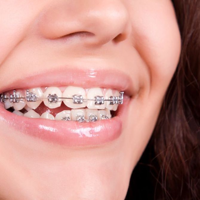 Los tipos de ortodoncia más utilizados en pacientes infantiles