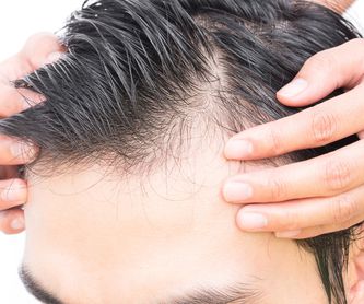 Alopecia hombres: Products de SG Centros capilares y Estética