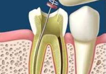 Endodoncias