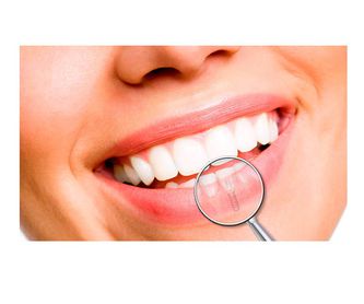 Odontología preventiva: Servicios de Dental Implantes
