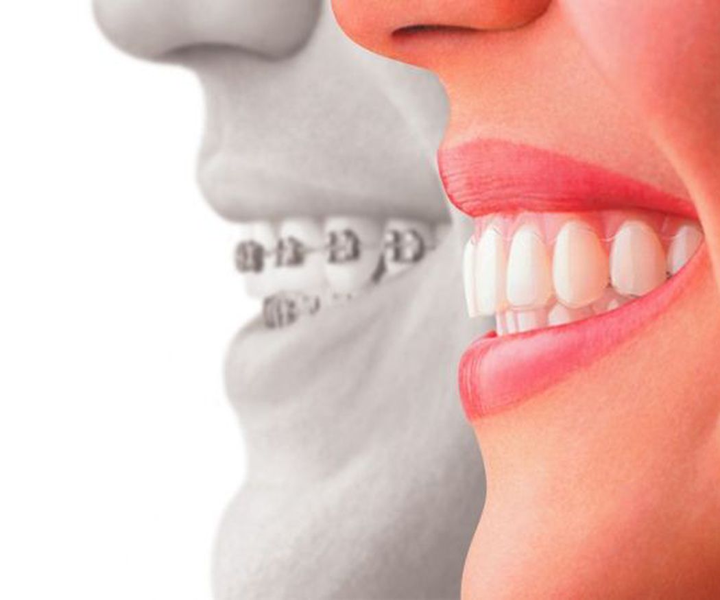 ¿Cómo funciona el tratamiento de ortodoncia invisible?