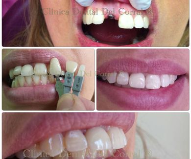 implantes dentales como solución estética.