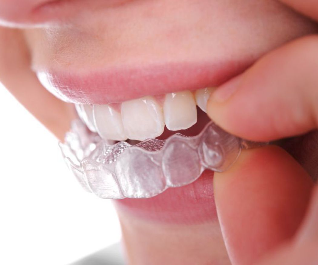 ¿En qué me beneficiará una ortodoncia dental?