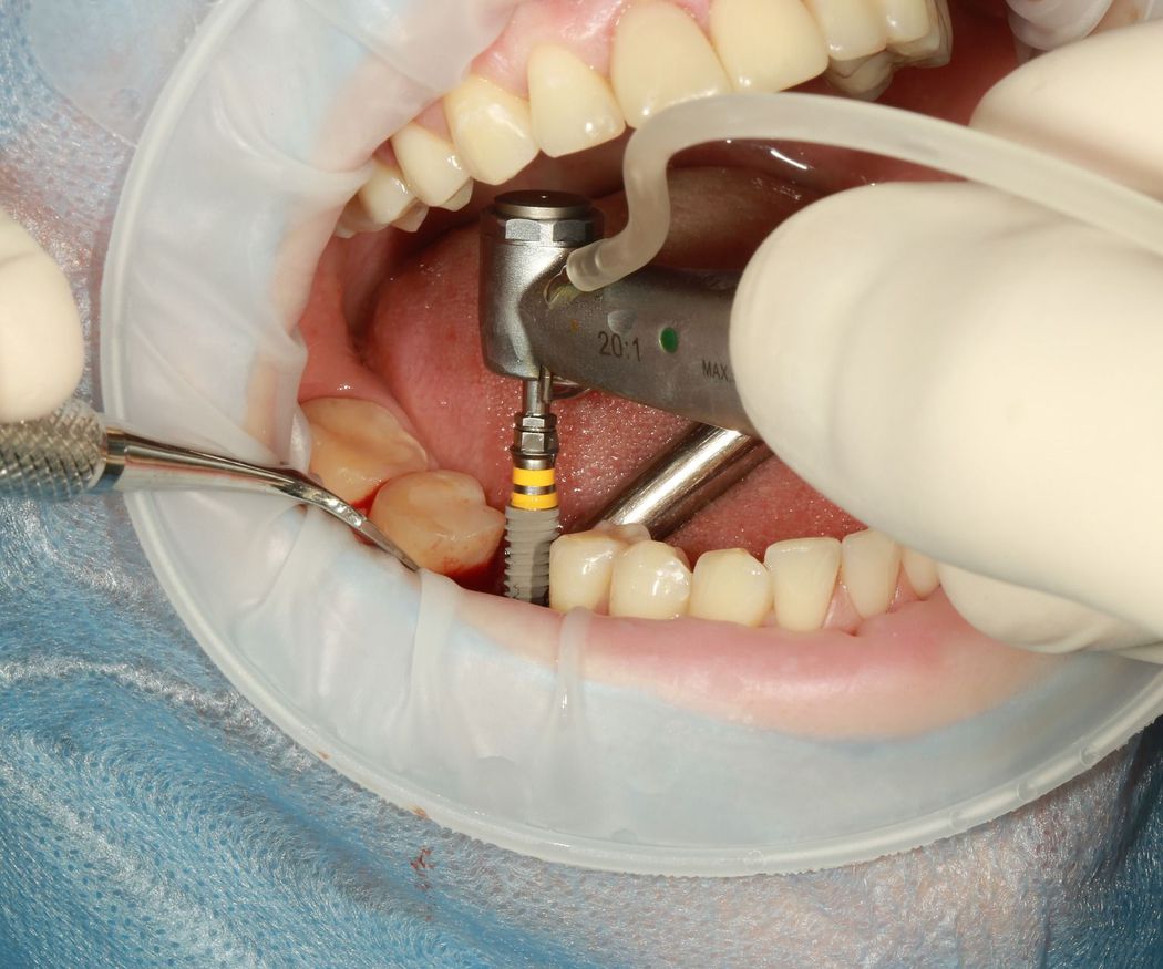 Cuestiones básicas sobre los implantes dentales