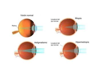 Desprendimiento retina: Patologías oculares de Oftalmólogo Cristina Mantolán Sarmiento