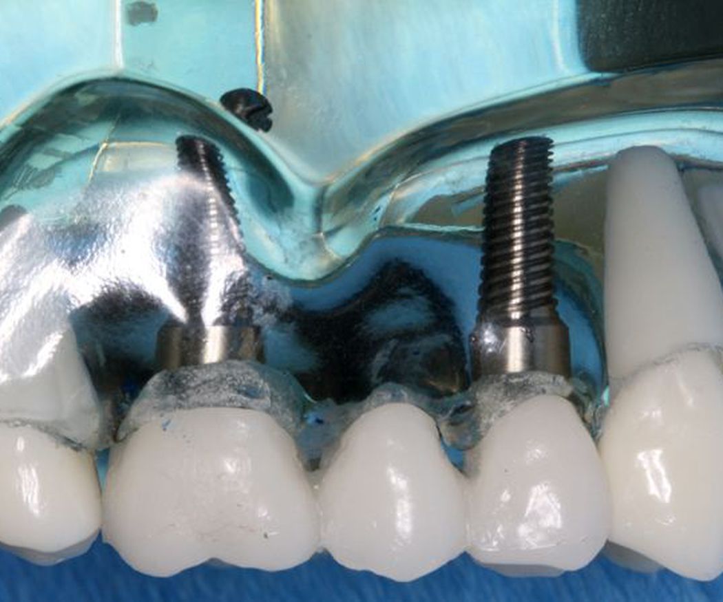Los implantes guiados 3D