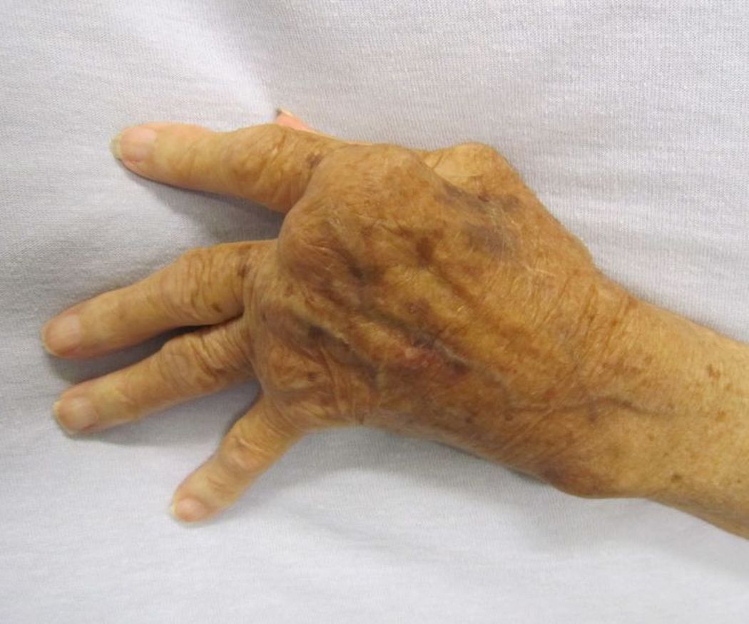 La artritis