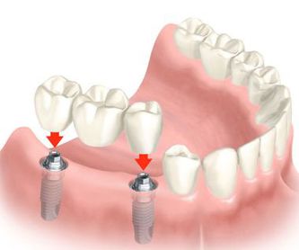 Implantología: Tratamientos de Centro Dental Europa